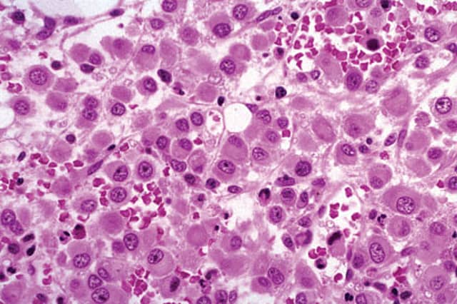 Cancer’s Penicillin Moment