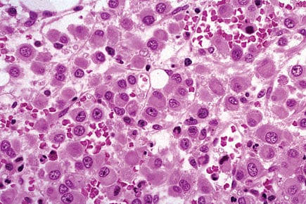 Cancer’s Penicillin Moment Cancer’s Penicillin Moment