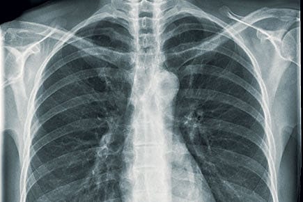 How TB Tricks the Body