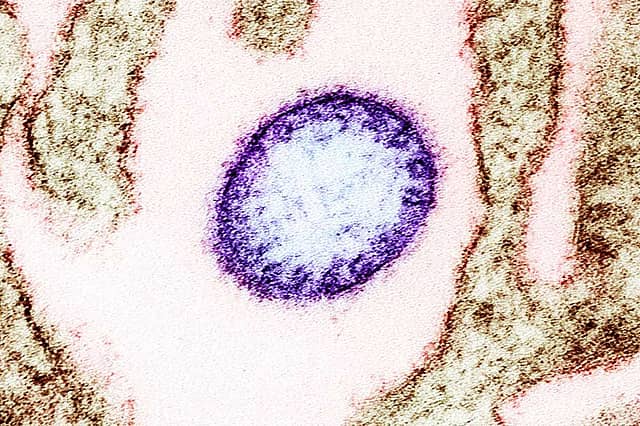 Diagnosis of Nipah virus infection in Kerala tougher than in 2018: Expert