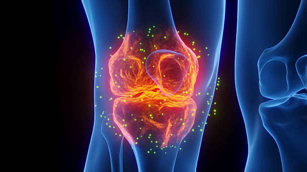 Breaking Myths About Arthritis