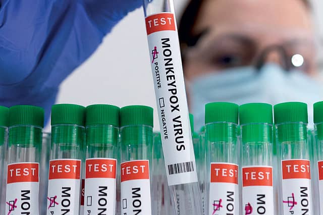 Mpox: The Anxiety Virus